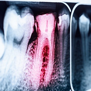 red tooth on x-ray