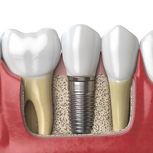 Illustration of dental implant between natural teeth