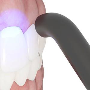 Illustration of curing light being used on dental bonding