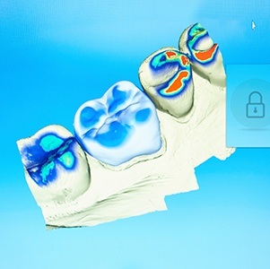 cerec image