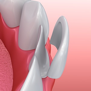 close illustration of porcelain veneer