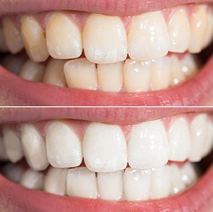 whitening before and after