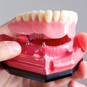 implant denture