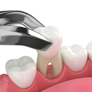 Illustration of forceps removing a tooth