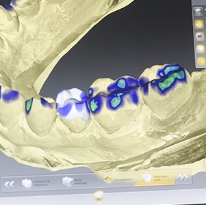 CEREC impression