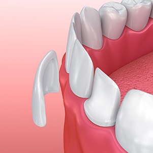 illustration of veneer