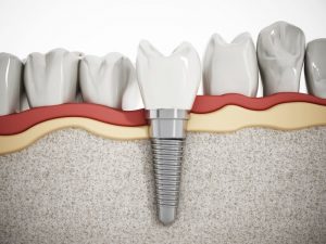 dental implant diagrams