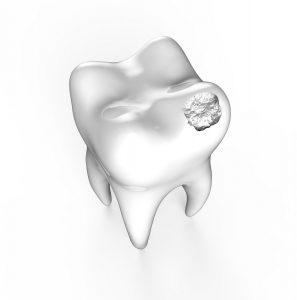 tooth with cavity 