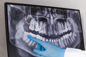 Gloved hand pointing at dental X-Ray in Colorado Springs