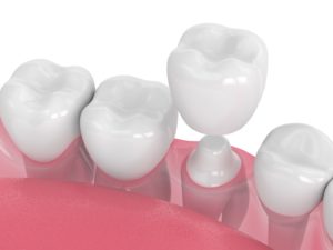 Illustration of CEREC crown being placed on tooth