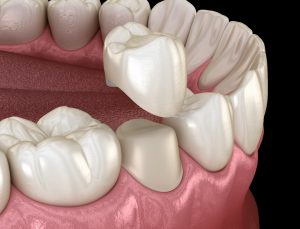 Illustration of dental crown being placed on tooth