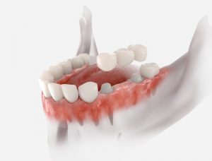 Illustration of three-unit dental bridge for lower arch