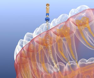 Illustration of tool cleaning tooth’s interior during root canal in Colorado Springs