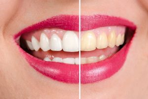 Woman’s yellow teeth in Colorado Springs before and after whitening treatment