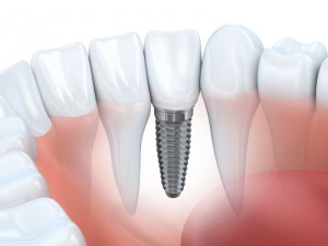 implant retained dentures colorado springs