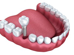 dental implants in Colorado Springs