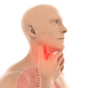 throat cancer concept